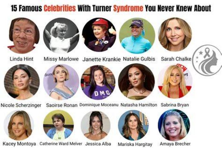 Celebrities With Turner Syndrome Health Guide Net