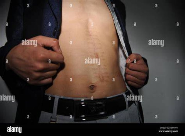 Kidney operation scar stock photo. Image of woman, scar 13282514