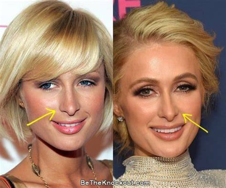 Paris Hilton Plastic Surgery Nose Job and Boob Job Before After