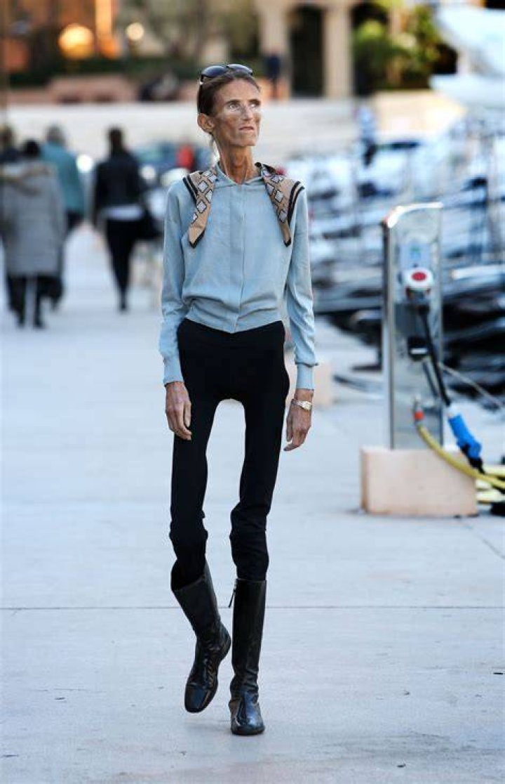 Valeria Levitin,The World&rsquo;s Thinnest Woman Campaigns Against Anorexia