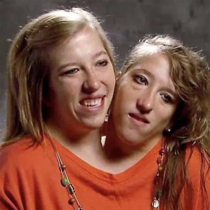 What Famous Conjoined Twins Abby And Brittany Hensel are Doing Today