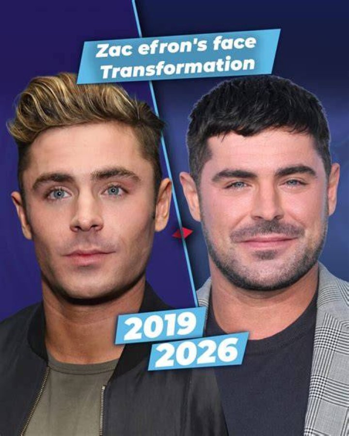 Zac Efron Face Before & After Jaw Surgery, Plastic Surgery, Filler